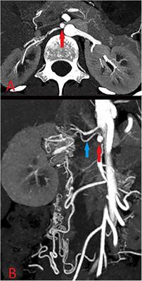 An accessory renal aneurysm in a patient with absent renal artery: a case report